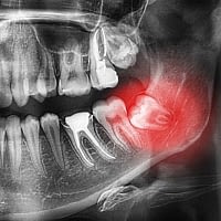 Poorly positioned wisdom teeth - Kenosha Dentist
