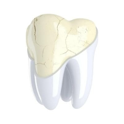 Dental Crown - crazed tooth - Kenosha Dentist