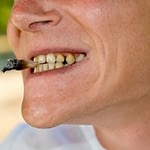 Yellow Teeth - Smoking - Kenosha Dentist