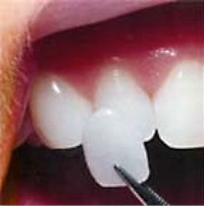 picture-of-porcelain-veneers