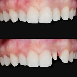 Zirconium Crown - Dental Technology - Pat Crawford DDS