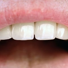 Dentist-Smooth-Tooth-Polishing - Kenosha Dentist