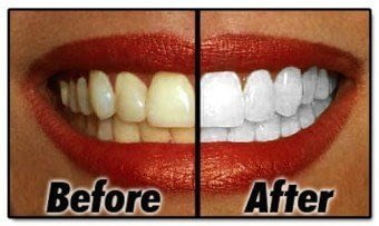 teeth whitening picture