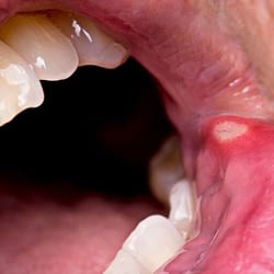 Oral Cancer Symptoms - Crawford DDS