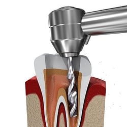 Drill - Root Canal - Kenosha Dentist