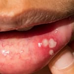 Oral Cancer - Mouth Sores - Wisconsin Dentist