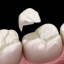 Healthy-tooth-structure-dental-onlay - Kenosha Dentist
