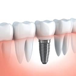 What are dental implants - How do I know if I need dental implants - Kenosha Dentist