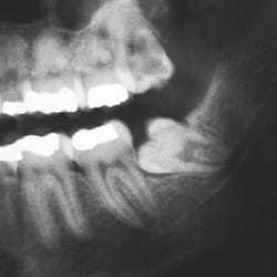 What are impacted wisdom teeth - Pat Crawford DDS
