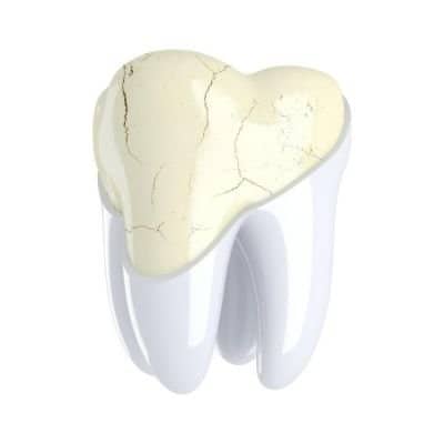 Dental Crown - crazed tooth - Kenosha Dentist
