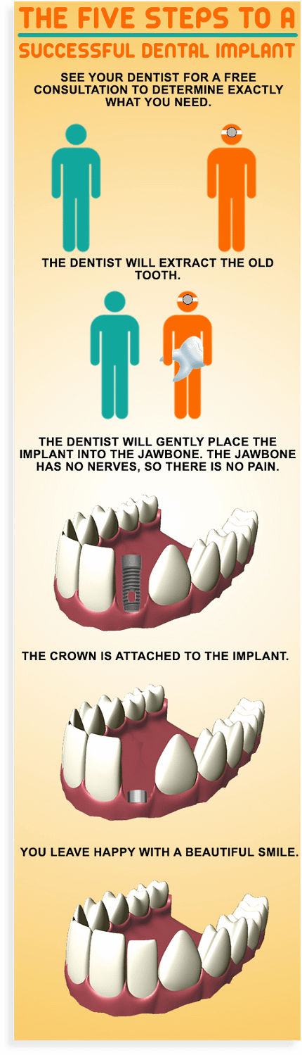 The_Five_Steps_to_A_Successful_Dental_Implant